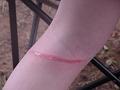 Rope burn on Gretchen's leg 2